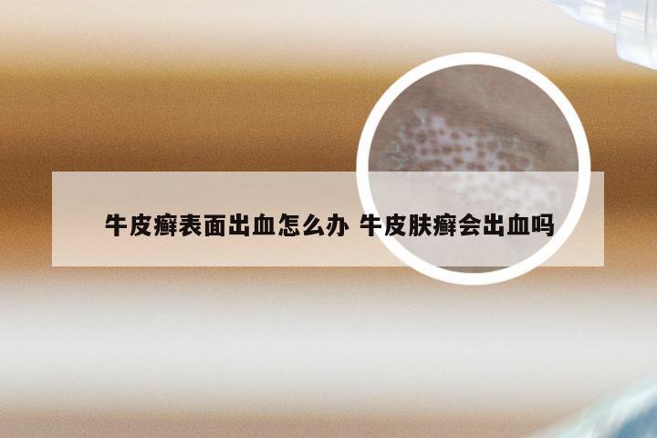 牛皮癣表面出血怎么办 牛皮肤癣会出血吗