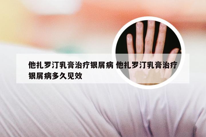 他扎罗汀乳膏治疗银屑病 他扎罗汀乳膏治疗银屑病多久见效