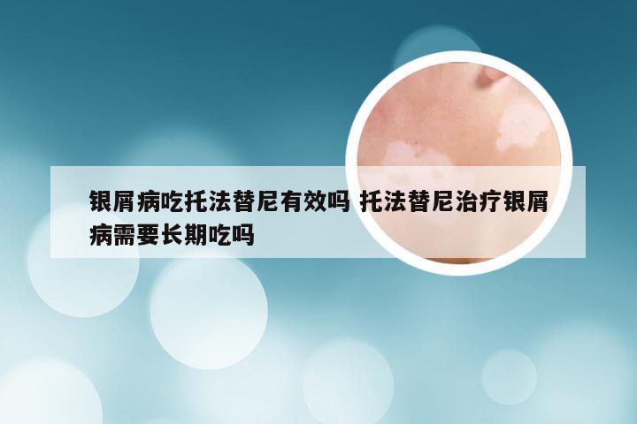 银屑病吃托法替尼有效吗 托法替尼治疗银屑病需要长期吃吗