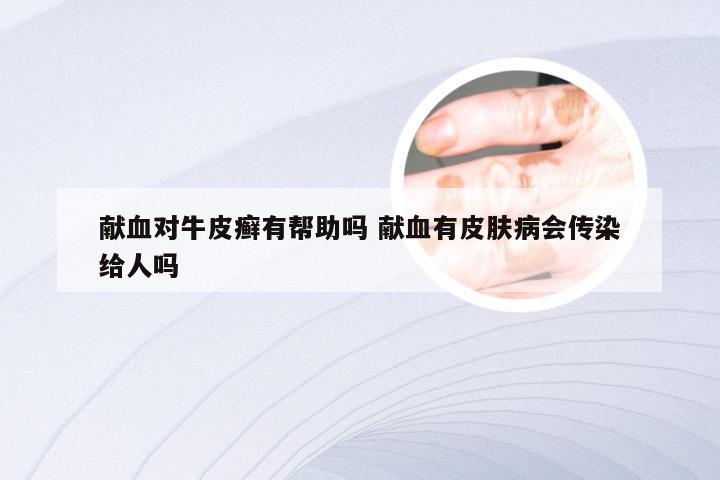 献血对牛皮癣有帮助吗 献血有皮肤病会传染给人吗