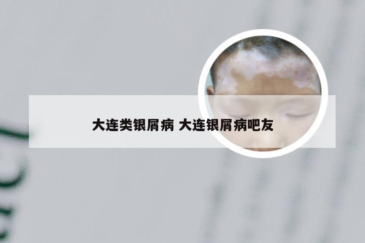 大连类银屑病 大连银屑病吧友
