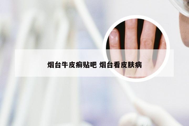 烟台牛皮癣贴吧 烟台看皮肤病