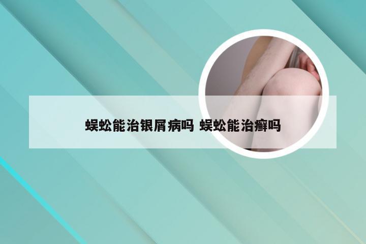 蜈蚣能治银屑病吗 蜈蚣能治癣吗