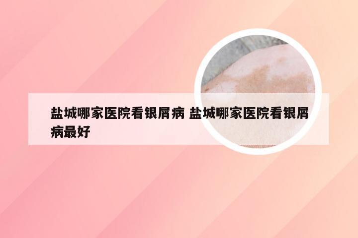 盐城哪家医院看银屑病 盐城哪家医院看银屑病最好