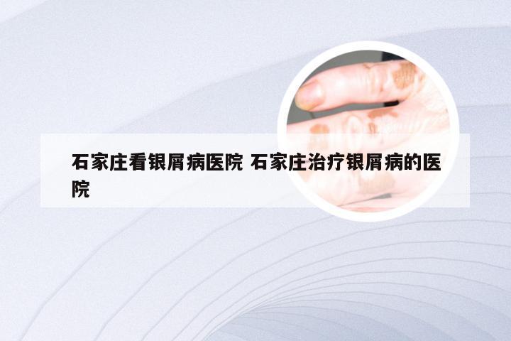 石家庄看银屑病医院 石家庄治疗银屑病的医院