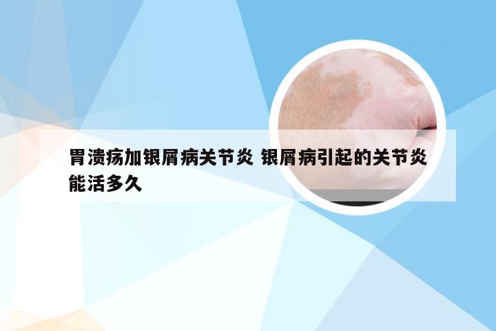 胃溃疡加银屑病关节炎 银屑病引起的关节炎能活多久