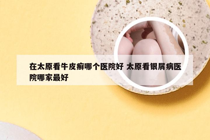 在太原看牛皮癣哪个医院好 太原看银屑病医院哪家最好