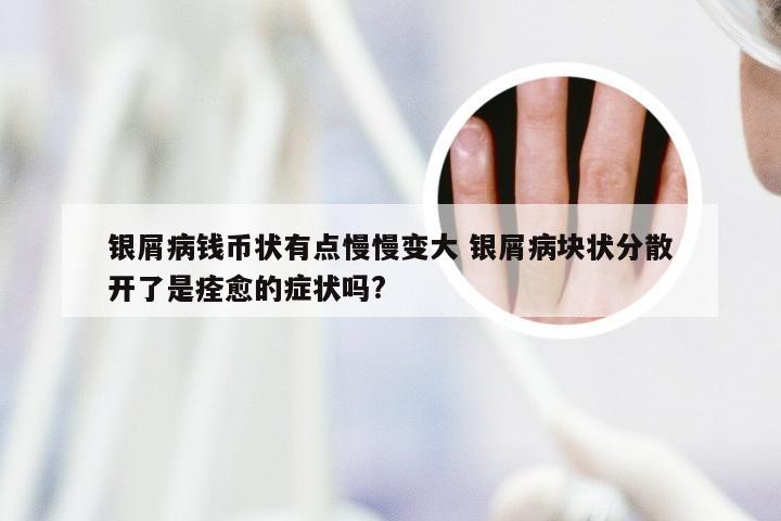 银屑病钱币状有点慢慢变大 银屑病块状分散开了是痊愈的症状吗?