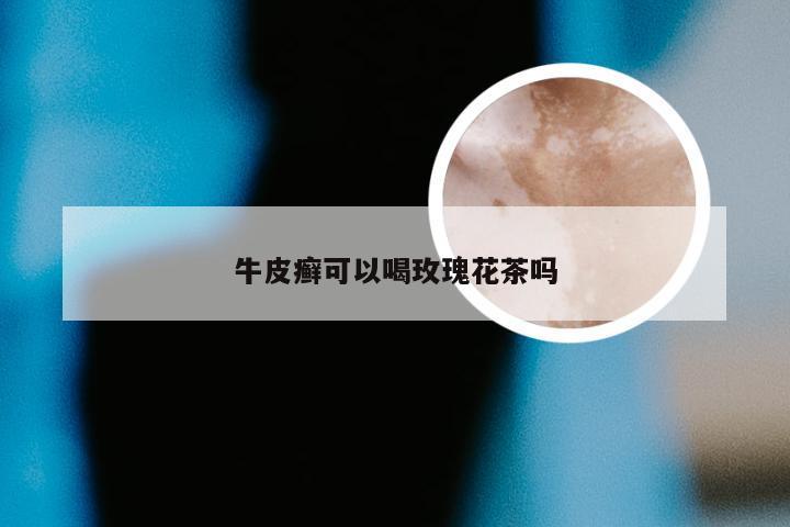 牛皮癣可以喝玫瑰花茶吗