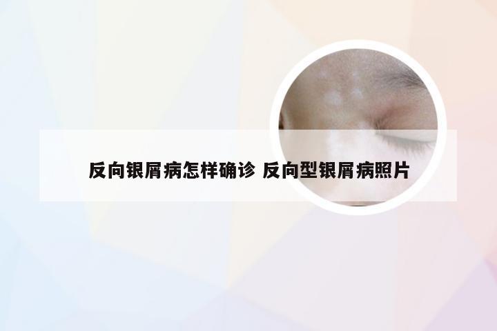 反向银屑病怎样确诊 反向型银屑病照片