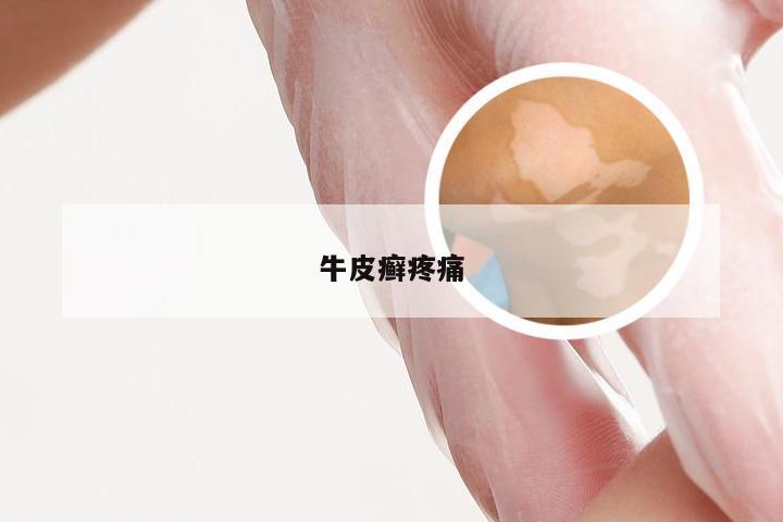 牛皮癣疼痛