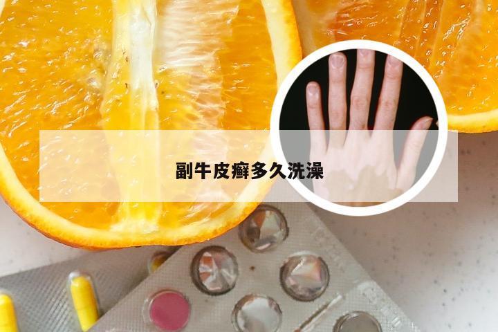 副牛皮癣多久洗澡
