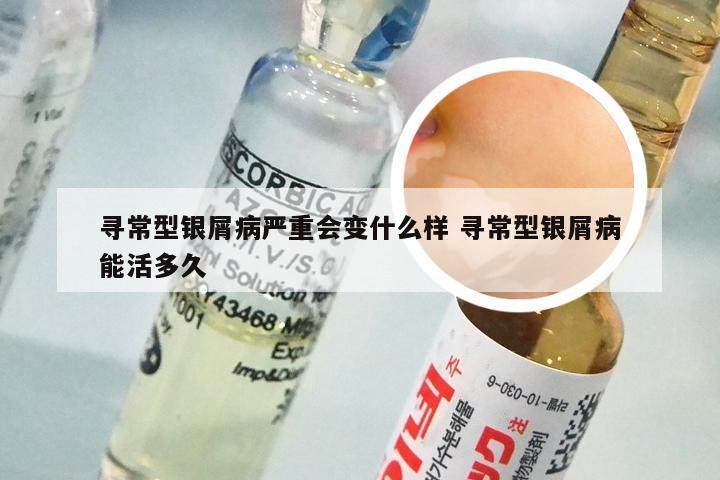 寻常型银屑病严重会变什么样 寻常型银屑病能活多久