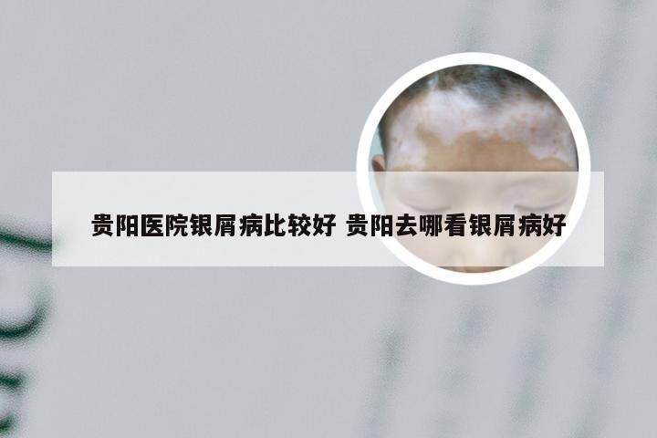 贵阳医院银屑病比较好 贵阳去哪看银屑病好