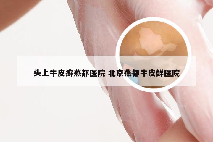 头上牛皮癣燕都医院 北京燕都牛皮鲜医院