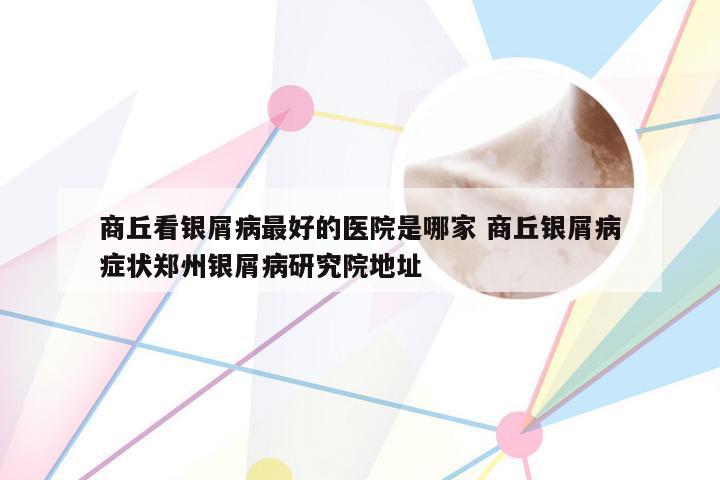 商丘看银屑病最好的医院是哪家 商丘银屑病症状郑州银屑病研究院地址
