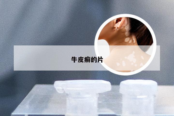 牛皮癣的片