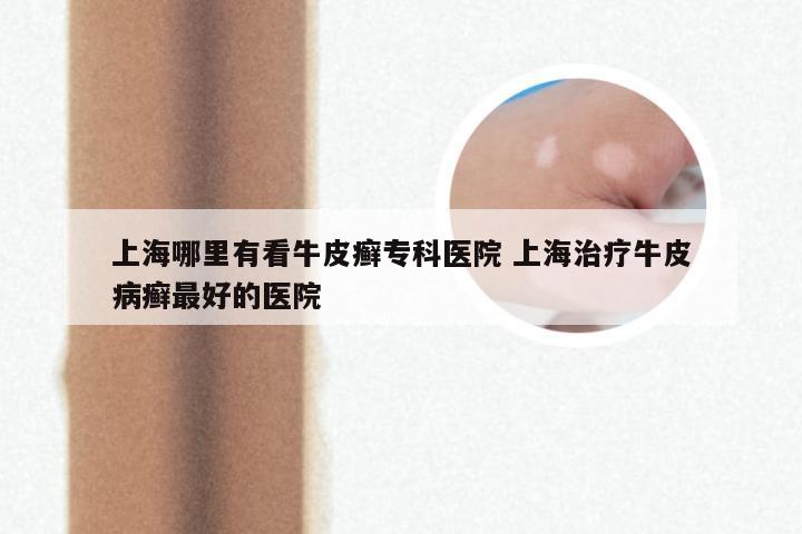 上海哪里有看牛皮癣专科医院 上海治疗牛皮病癣最好的医院