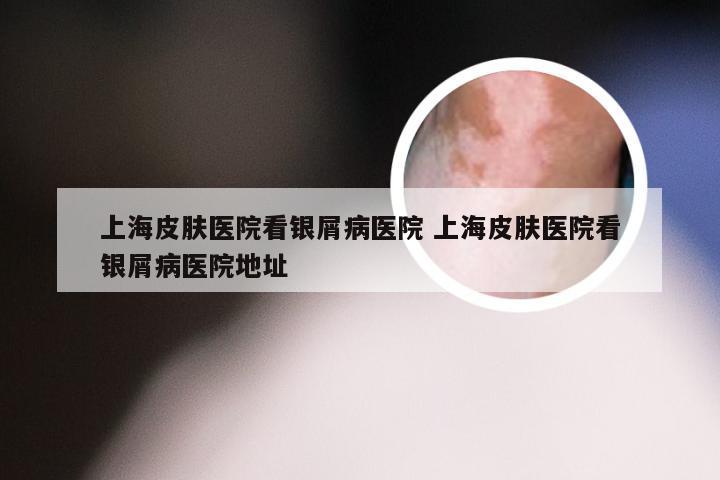 上海皮肤医院看银屑病医院 上海皮肤医院看银屑病医院地址