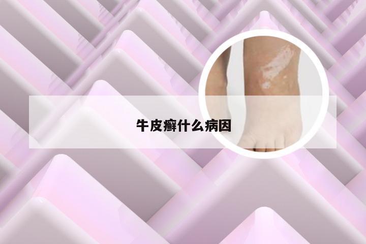 牛皮癣什么病因