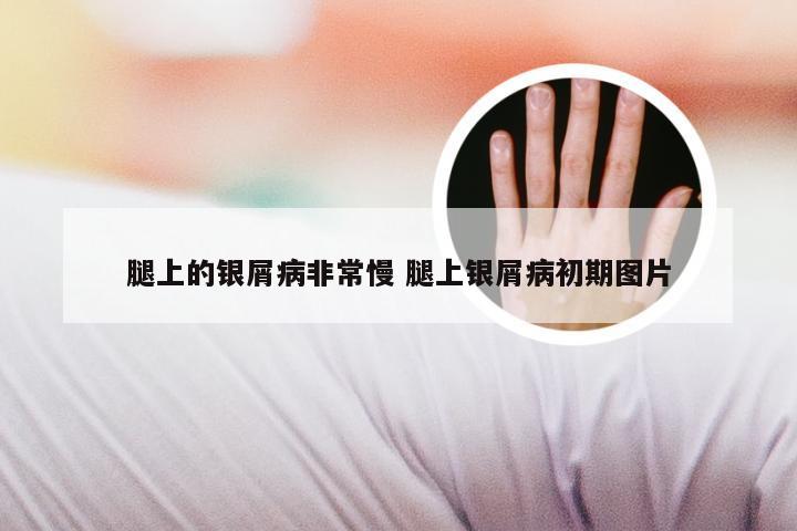 腿上的银屑病非常慢 腿上银屑病初期图片