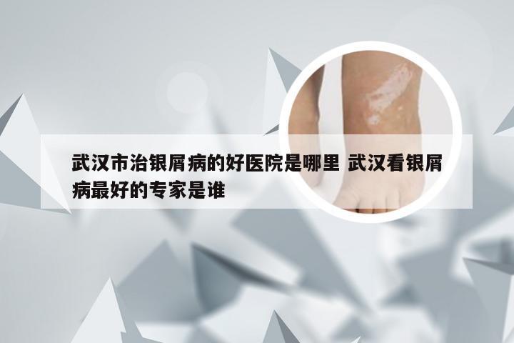 武汉市治银屑病的好医院是哪里 武汉看银屑病最好的专家是谁