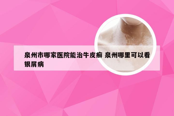 泉州市哪家医院能治牛皮癣 泉州哪里可以看银屑病