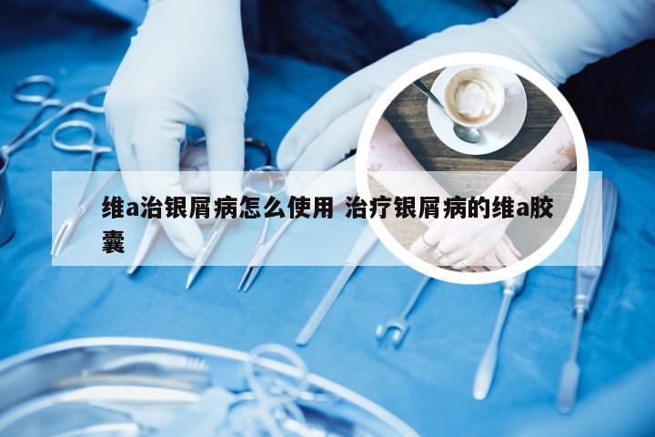 维a治银屑病怎么使用 治疗银屑病的维a胶囊