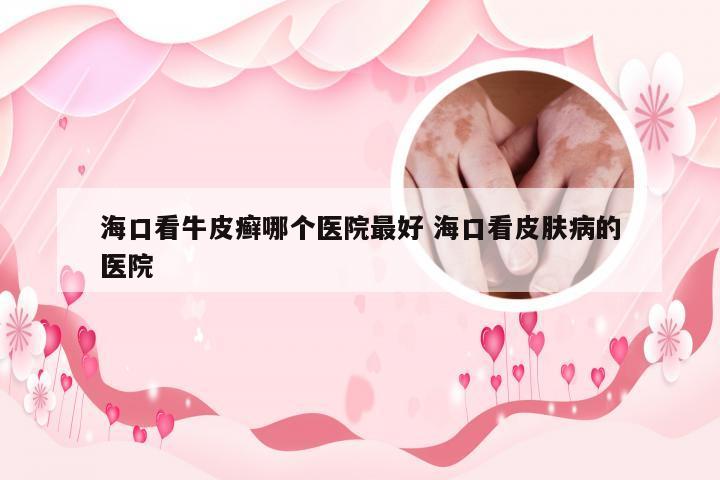海口看牛皮癣哪个医院最好 海口看皮肤病的医院