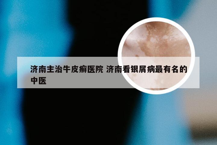 济南主治牛皮癣医院 济南看银屑病最有名的中医