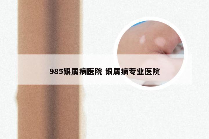 985银屑病医院 银屑病专业医院