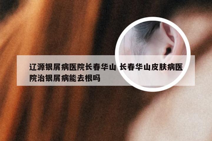 辽源银屑病医院长春华山 长春华山皮肤病医院治银屑病能去根吗
