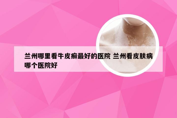 兰州哪里看牛皮癣最好的医院 兰州看皮肤病哪个医院好