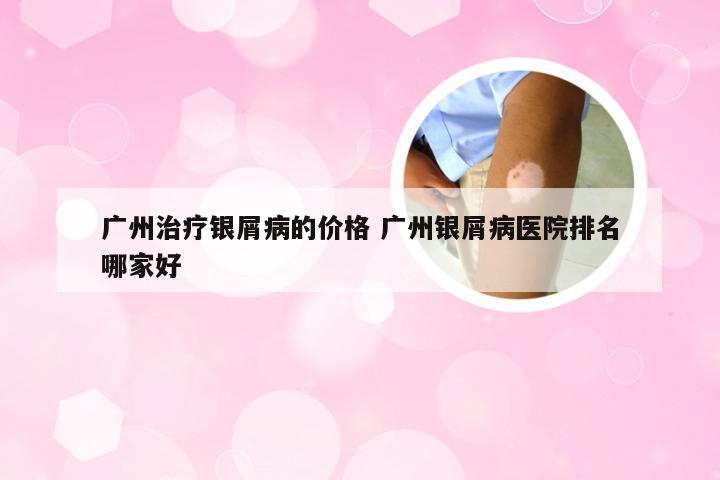 广州治疗银屑病的价格 广州银屑病医院排名哪家好