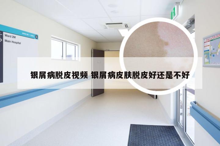 银屑病脱皮视频 银屑病皮肤脱皮好还是不好