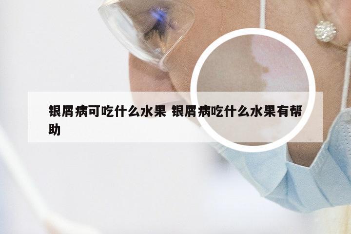 银屑病可吃什么水果 银屑病吃什么水果有帮助