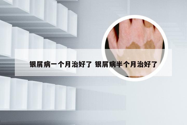 银屑病一个月治好了 银屑病半个月治好了