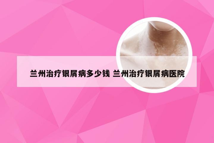 兰州治疗银屑病多少钱 兰州治疗银屑病医院