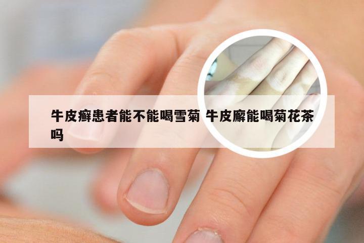 牛皮癣患者能不能喝雪菊 牛皮廨能喝菊花茶吗