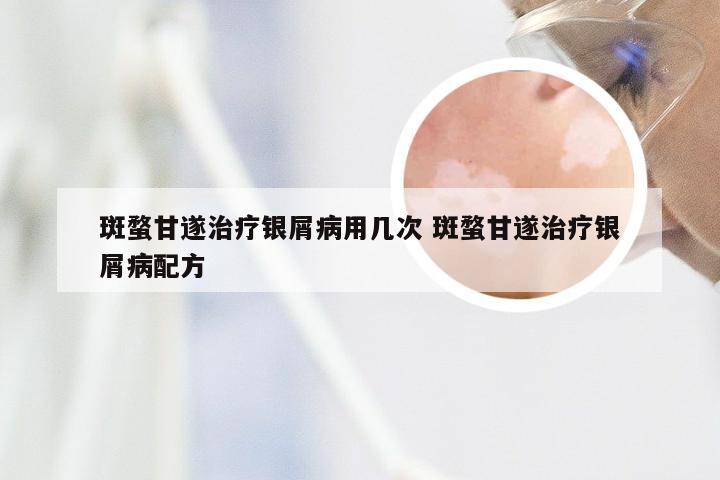 斑蝥甘遂治疗银屑病用几次 斑蝥甘遂治疗银屑病配方