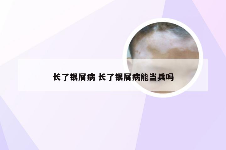 长了银屑病 长了银屑病能当兵吗