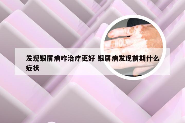 发现银屑病咋治疗更好 银屑病发现前期什么症状