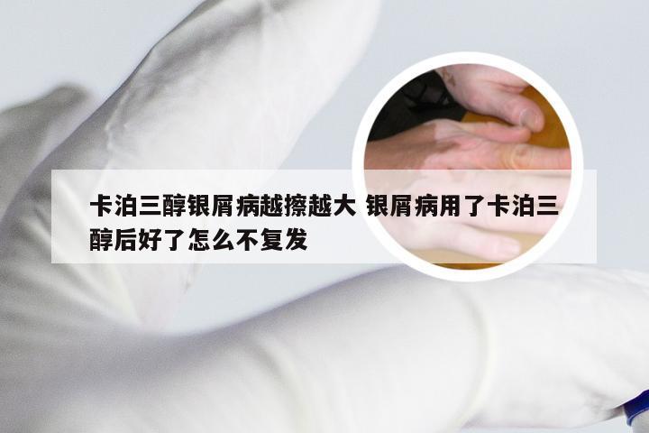 卡泊三醇银屑病越擦越大 银屑病用了卡泊三醇后好了怎么不复发