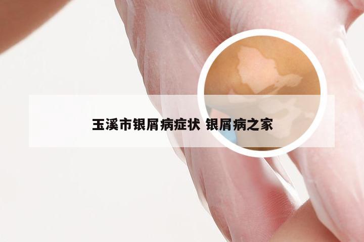 玉溪市银屑病症状 银屑病之家