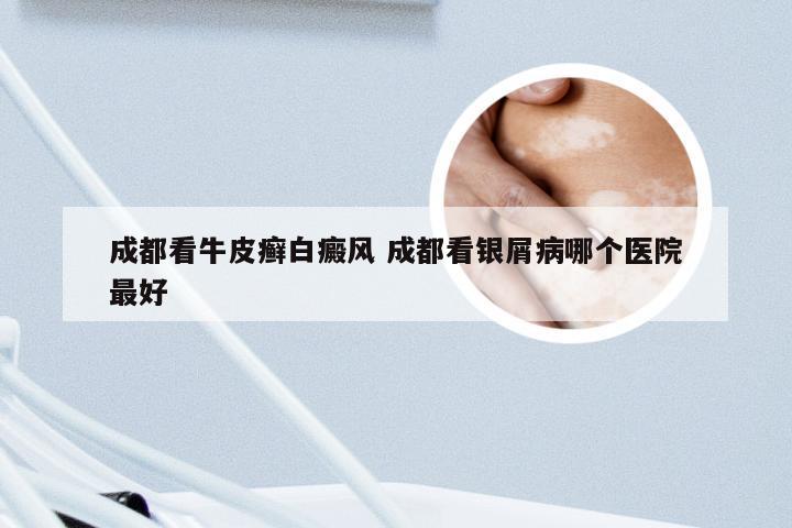 成都看牛皮癣白癜风 成都看银屑病哪个医院最好