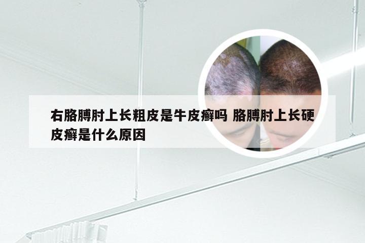 右胳膊肘上长粗皮是牛皮癣吗 胳膊肘上长硬皮癣是什么原因