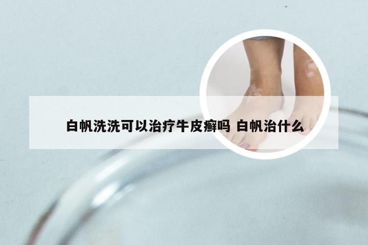 白帆洗洗可以治疗牛皮癣吗 白帆治什么