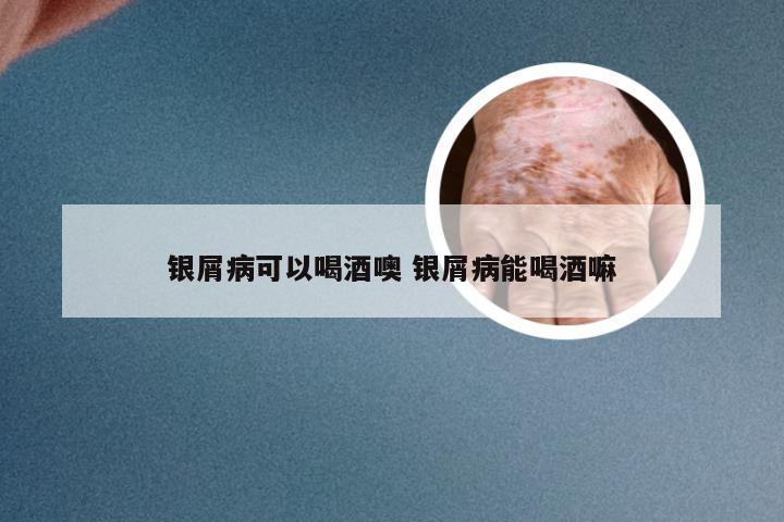 银屑病可以喝酒噢 银屑病能喝酒嘛