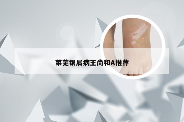 莱芜银屑病王尚和A推荐