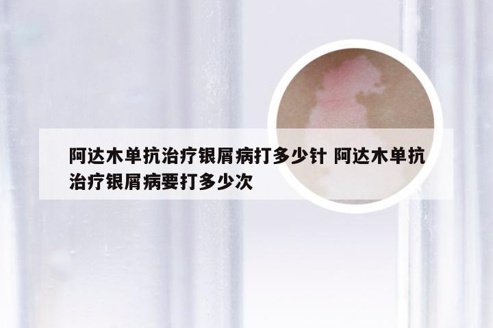 阿达木单抗治疗银屑病打多少针 阿达木单抗治疗银屑病要打多少次